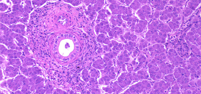 Colangitis 5