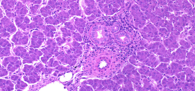 Colangitis 6