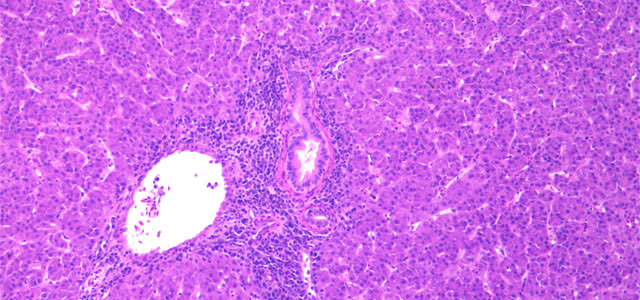 Colangitis Ib