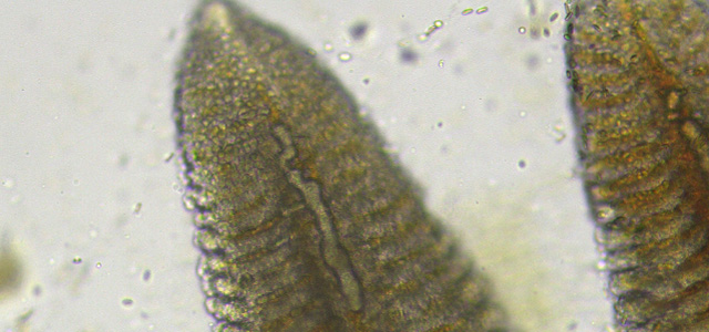 Embolia branquial I