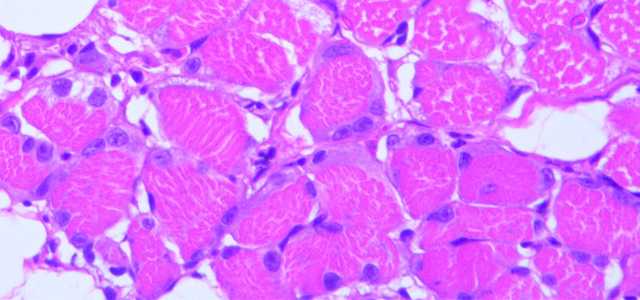 Miositis HSMIIV