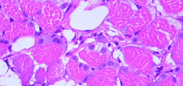 Miositis HSMIV