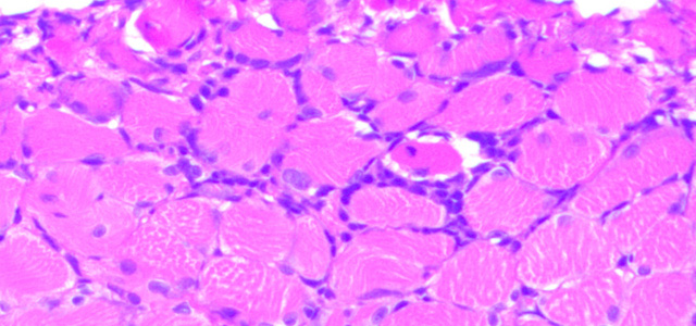 Miositis HSMI II