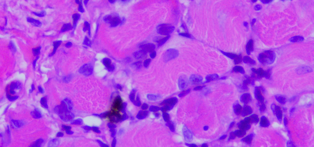 Miositis HSMI IX