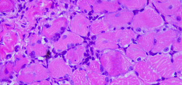 Miositis HSMI VII
