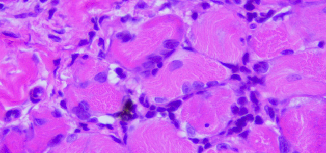Miositis HSMI VIII
