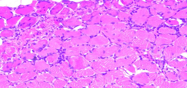 Mositis HSMI I