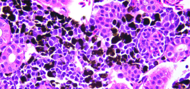 Salar BKD Melanomacrofagos V
