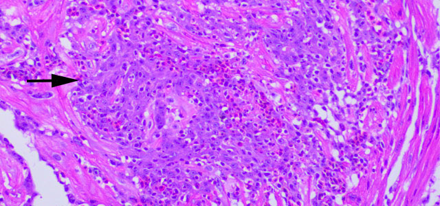 Miocarditis BKD 20x
