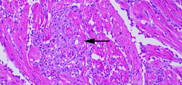 Miocarditis BKD 20x 7