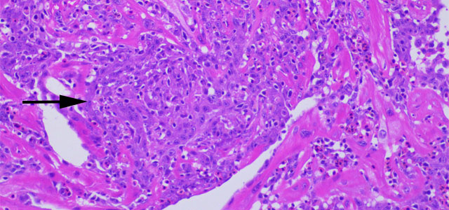 Miocarditis BKD 40x