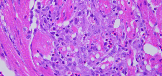 Miocarditis BKD 40x 12