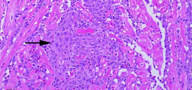 Miocarditis BKD 40x 6