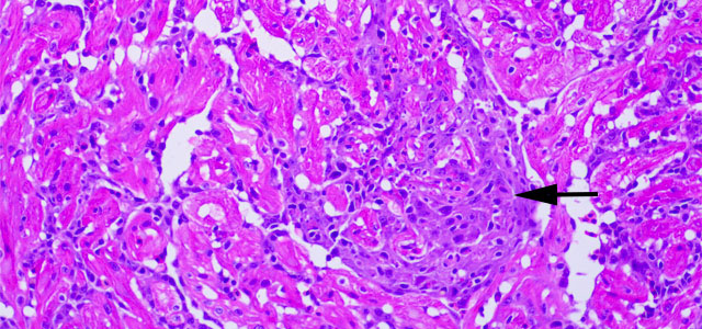 Miocarditis BKD 40x 9