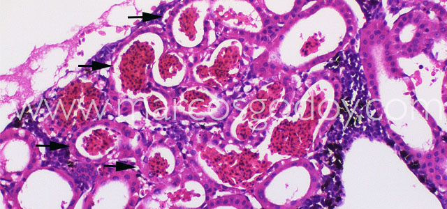 Hemorragia 20X IV