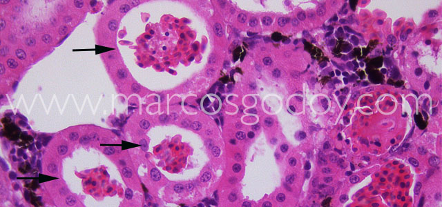 Hemorragia 40X III