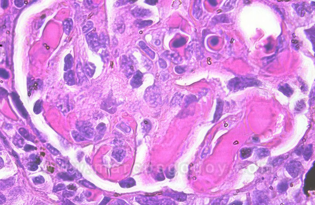 Glomerulonefritis membranosa autoinmune en Salmón del Atlántico (Salmo salar): Histopatología I