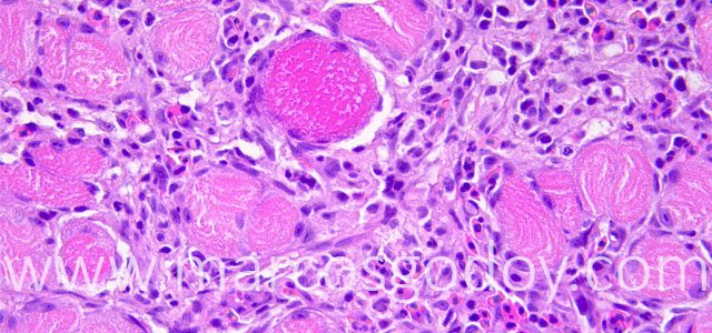Miositis Flavobacterium Trucha 40X VI