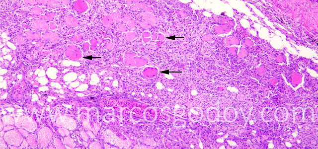 Miositis Flavobacterium Trucha I