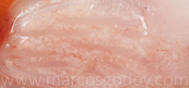 IPN visceral fat gross pathology XV