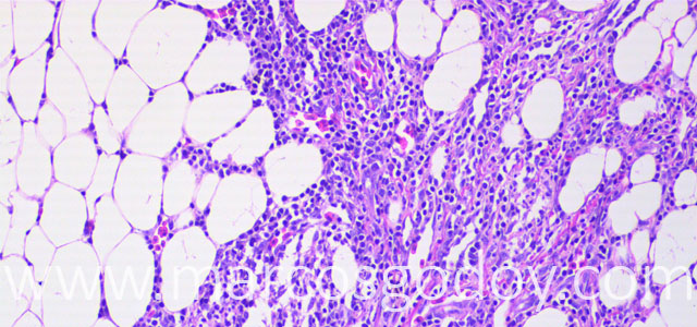 Esteatitis 20X I