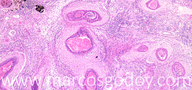 Nefritis granulomatosa 10X I