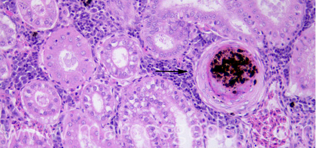Nefritis granulomatosa 40XI VI