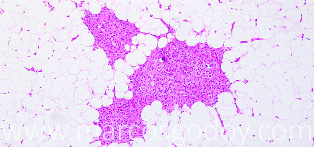 Esteatitis 10X I