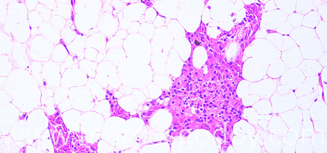 Esteatitis 20X II