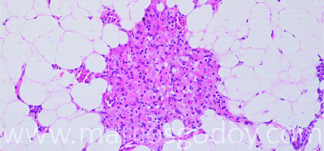 Esteatitis 20X IV