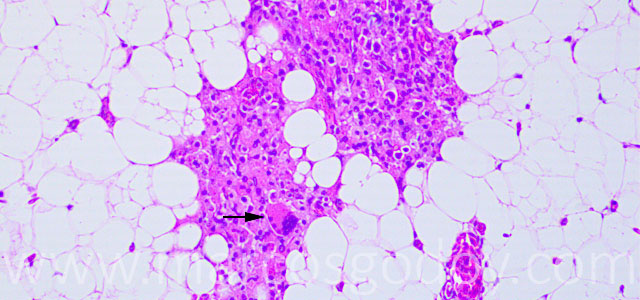 Esteatitis 20X V