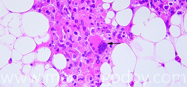 Esteatitis 40X VI