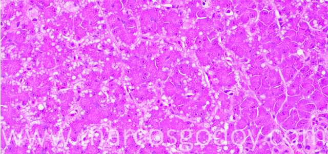 Microvesicular steatosis 10X 1