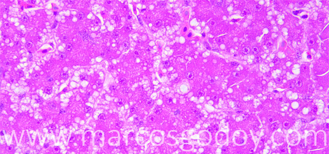 Microvesicular steatosis 40X 1