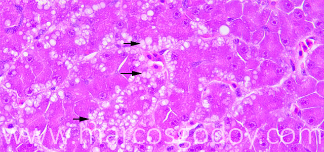 Microvesicular steatosis 40X III