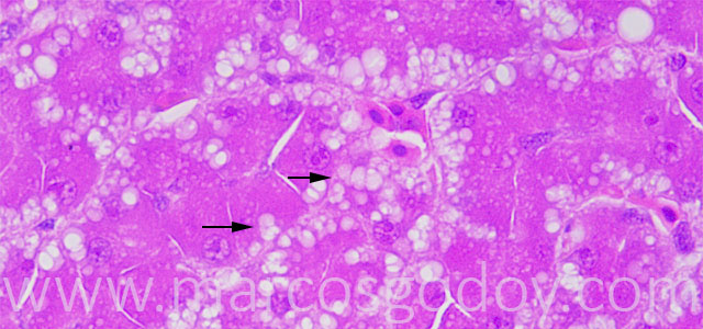 Microvesicular steatosis 63X IV