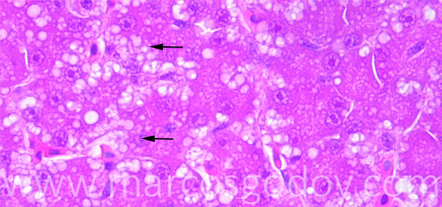 Microvesicular steatosis 63X V