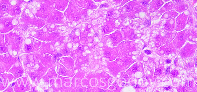 Microvesicular steatosis 63X VI