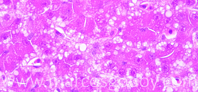 Microvesicular steatosis 63X VII