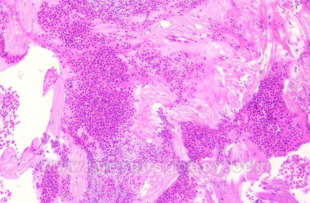 Ruptura auricular en Salmón coho (Oncorhynchus kisutch) que cursan con disturbio circulatorio generalizado II: Histopatología
