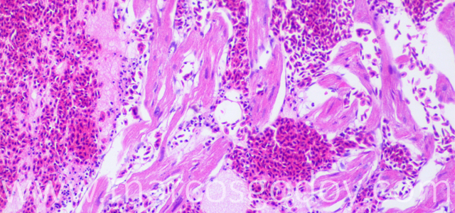 Ruptura auricular 10X IV