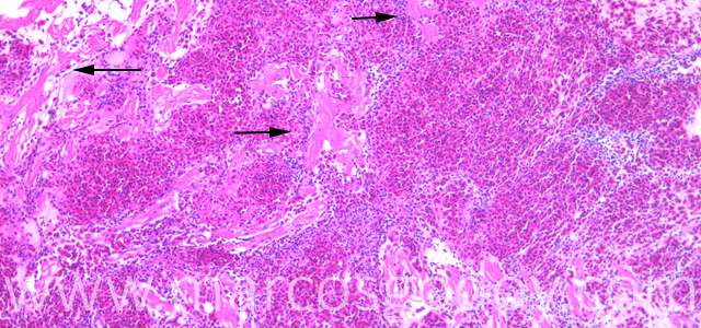 Ruptura auricular 10X IX