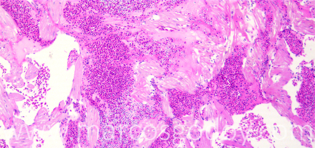Ruptura auricular 10X XV