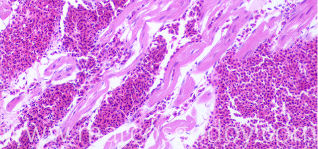 Ruptura auricular 20X VII