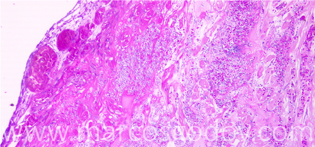 Ruptura auricular 4X VI