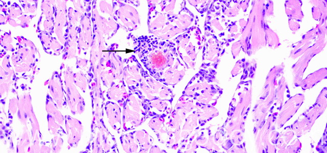 Miocarditis Altantic salmon 200X III
