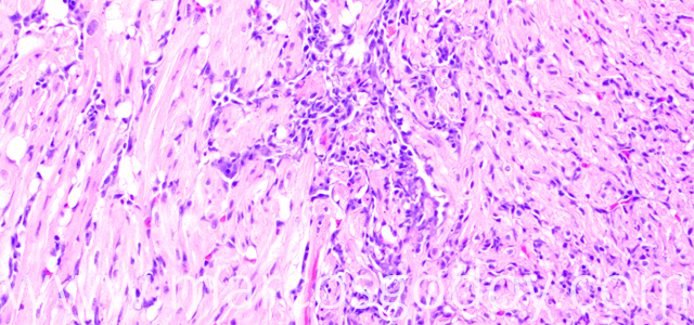 Miocarditis Altantic salmon 200X V