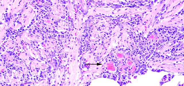 Miocarditis Altantic salmon 200X VII