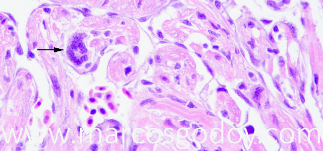 Miocarditis giant cel II