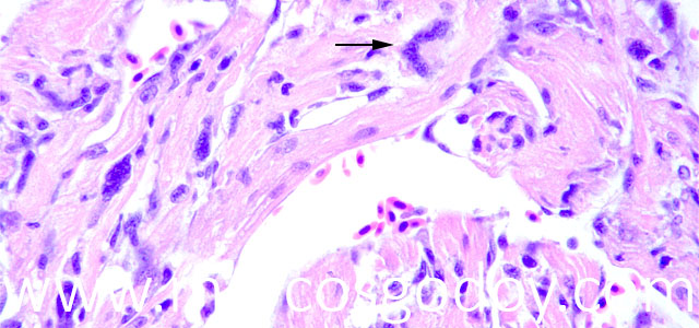 Miocarditis giant cel III